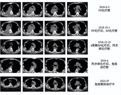 kaiyun体育 大咖评新锐 | 审慎计划肺癌病理学类型，二次活检明确诊断，免疫诊治改善预后